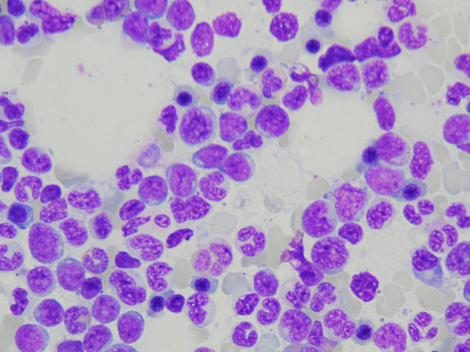 Bone marrow, high power, initial diagnosis